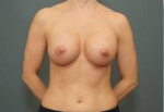 BREAST AUGMENTATION: Case 28 After